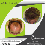 مركز بروفيشونال كلينيك لزراعة الشعر وعمليات التجميل