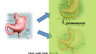 تصغير المعدة