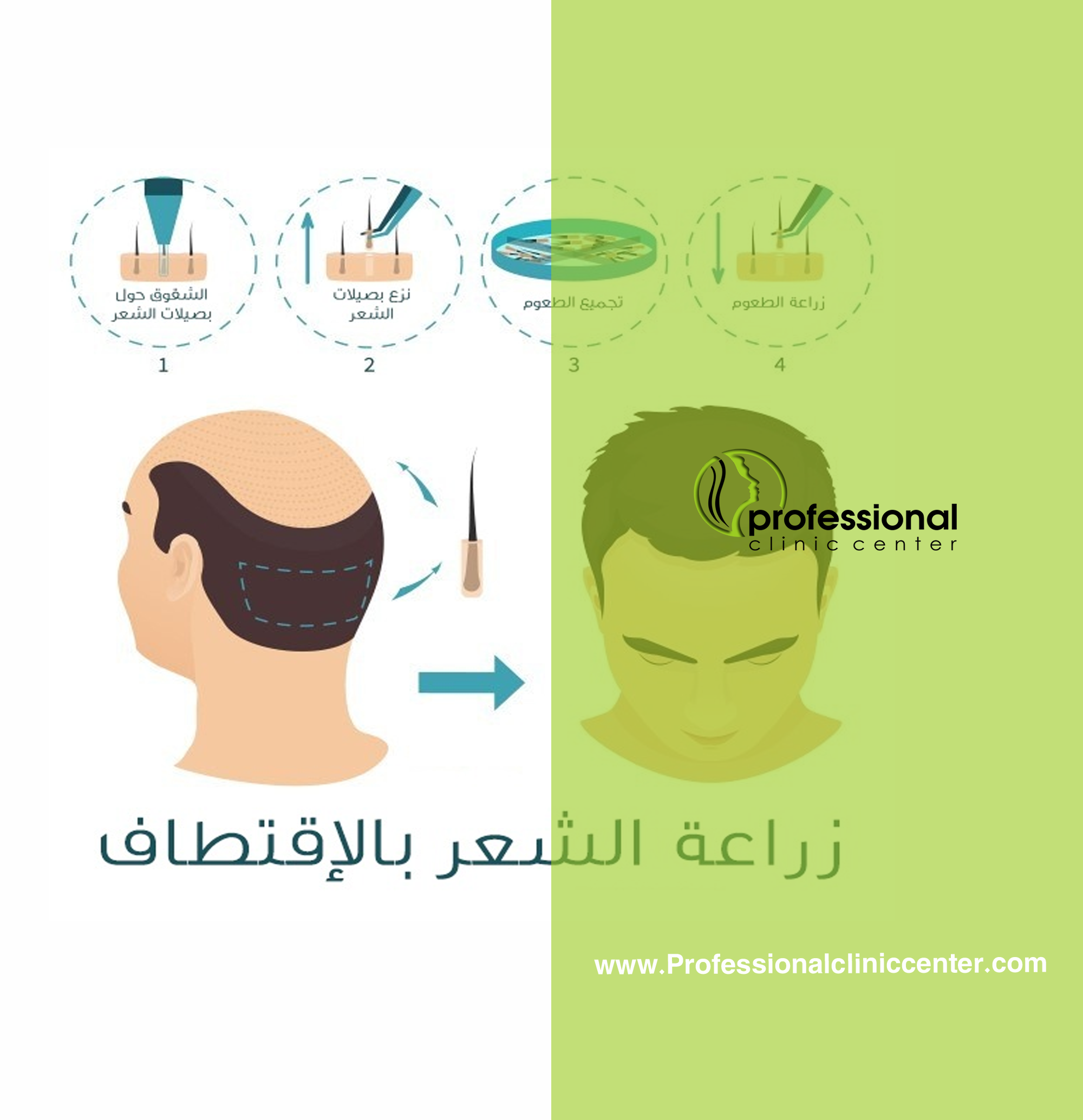 زراعة الشعر بالاقتطاف